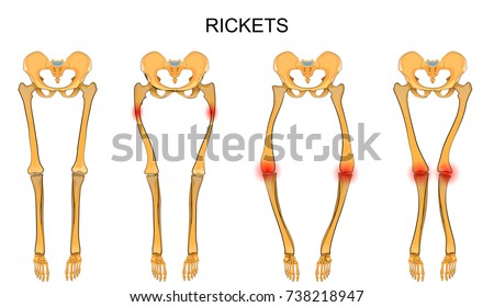 Rickets Stock Images, Royalty-Free Images & Vectors | Shutterstock