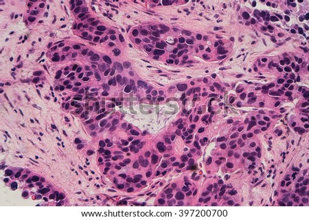 Breast Biopsy Stock Images, Royalty-Free Images & Vectors | Shutterstock