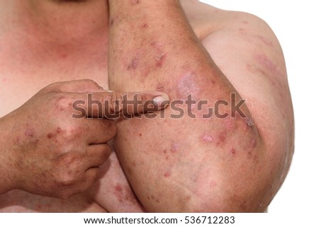 A psoríase é uma doença auto-imune que afeta a pele, causando inflamação da pele vermelha e escamosa.