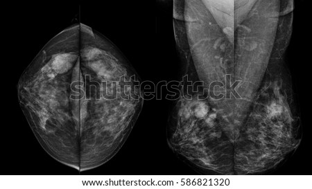 Mammography x ray and breast tissue