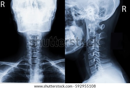 Film x-ray c-spine (AP,Lateral view) : show normal human's c-spine or cervical spine
