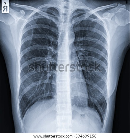 Chest Xray Lungs Young Girl Diagnosis Stock Photo 66099106 - Shutterstock