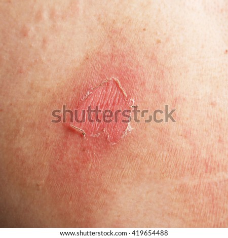 macro texture of burns on human skin back stock photo 415678729 bite leg blood stock photo 306747611 macro texture of burns on human skin back stock photo 415678729 bite leg blood stock photo 306747611