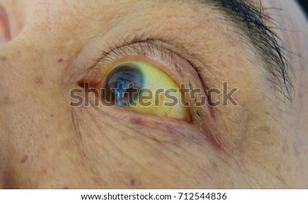 obstructive jaundice