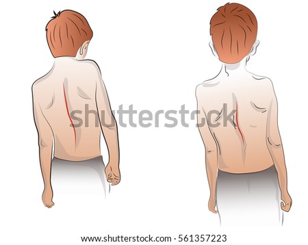 back curvature scoliosis