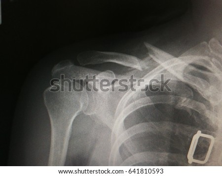 Clavicle Stock Images, Royalty-Free Images & Vectors | Shutterstock