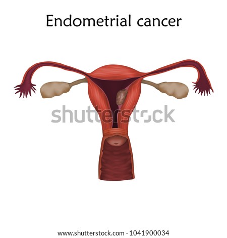 endometrial cancer essay Endometrial cancer — the most common type of uterine cancer — is the fourth most common malignancy among women in the united states, trailing only breast, lung and colorectal cancers. endometrial cancer essay Endometrial cancer — the most common type of uterine cancer — is the fourth most common malignancy among women in the united states, trailing only breast, lung and colorectal cancers.