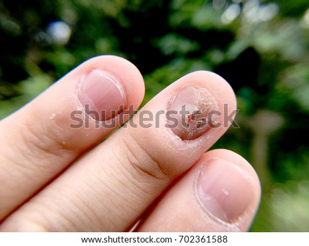 Dermatophytes Stock Images, Royalty-Free Images & Vectors | Shutterstock