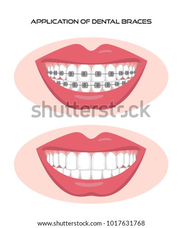 Braces Cartoon Stock Images, Royalty-Free Images & Vectors | Shutterstock