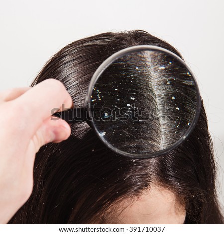 Dandruff Stock Images, Royalty-Free Images & Vectors 