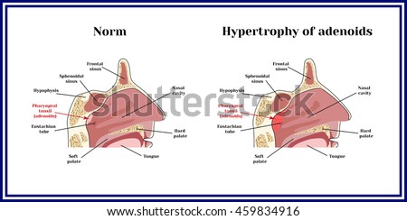 Location Adenoids Structure Nasopharynx Norm Hypertrophy Stock Vector