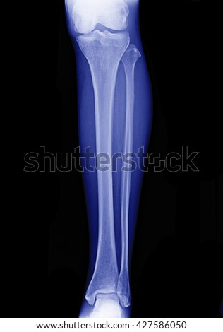 Broken Lower Leg Xray Front View Stock Photo 48374887 - Shutterstock