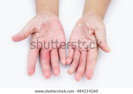 Fungal Skin Rash On Hands