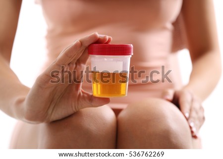 Cup with yellow color urine sample for analysis on urinary infection