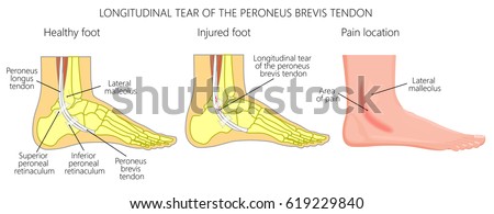 Vector Diagram Arches Foot Medial Lateral Stock Vector 478538809 ...