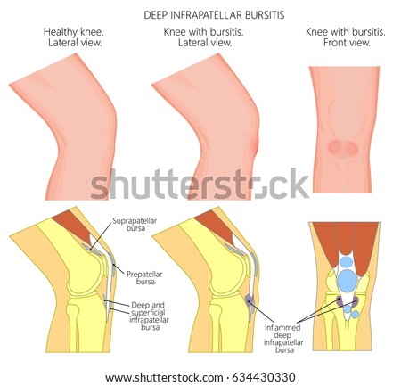 stock vector vector illustration of a healthy knee and unhealthy knee with deep infrapatellar bursitis or 634430330