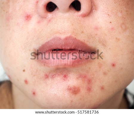 skin scar stock images royalty free images vectors problematic skin scars acne scar stock photo royalty free 517581736 skin scar stock images royalty free images vectors problematic skin scars acne scar stock photo royalty free 517581736