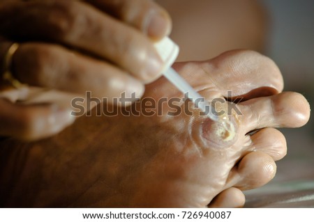 wart salicylic acid treatment foot focus lighting led light shutterstock plantar