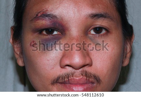facial injection bruises in the brow very tinny girl nude