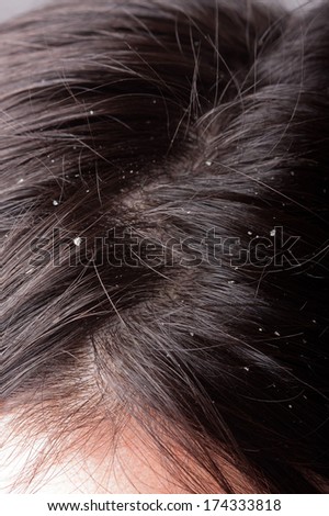 Persistent Dandruff Issue Flaky Scalp Stock Photo 83747296 - Shutterstock