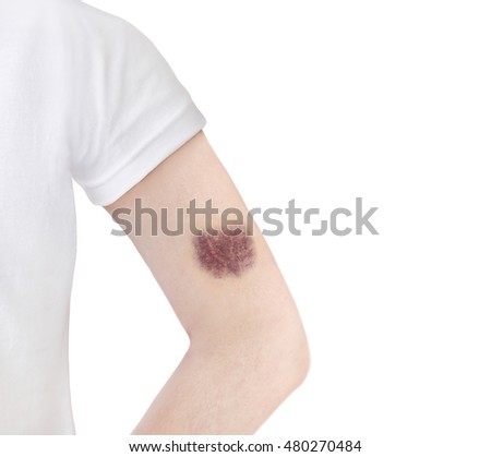 Bruise Stock Images, Royalty-Free Images & Vectors | Shutterstock