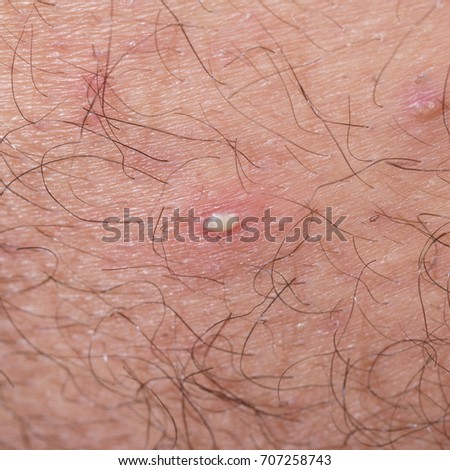Excrescent Stock Images Royalty Free Images Vectors Shutterstock
