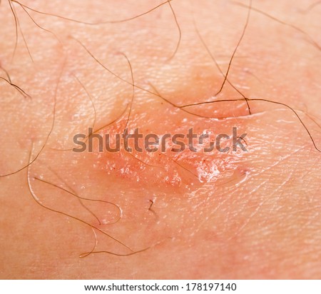 macro texture of burns on human skin back stock photo 415678729 stock images royalty free images vectors macro texture of burns on human skin back stock photo 415678729 stock images royalty free images vectors