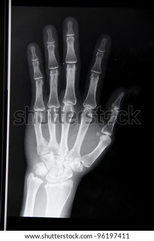 xray stock news