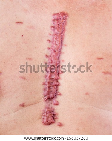 skin scar stock images royalty free images vectors skin scar stock images royalty free images vectors skin scar stock images royalty free images vectors skin scar stock images royalty free images vectors
