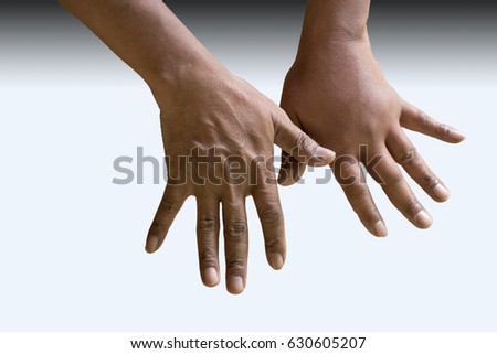 Swollen Hands Stock Images, Royalty-Free Images & Vectors | Shutterstock