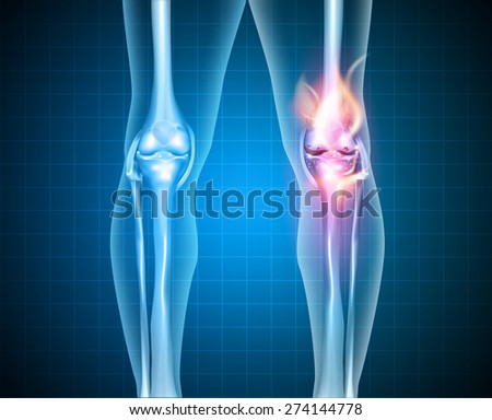 research paper osteoarthritis Samantha olewnik biology of aging – research paper professor kobre april 30, 2013 osteoarthritis of the spine there are many types of arthritis, the most common being osteoarthritis. research paper osteoarthritis Samantha olewnik biology of aging – research paper professor kobre april 30, 2013 osteoarthritis of the spine there are many types of arthritis, the most common being osteoarthritis.