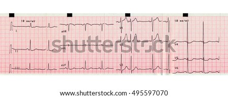 Normal Heart Ecg Trace Compared Abnormal Stock Vector 315511919