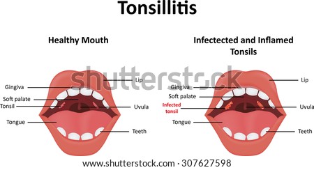 Tonsils Stock Photos, Royalty-Free Images & Vectors - Shutterstock