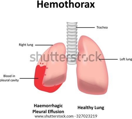 Hemothorax Stock Illustration 327023219 - Shutterstock