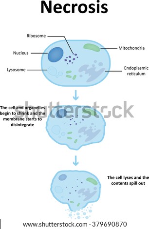 Necrosis Stock Images, Royalty-Free Images & Vectors | Shutterstock