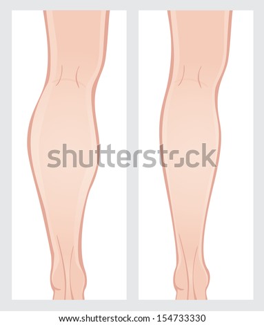 Vyvanse and weight loss supplements photo 2