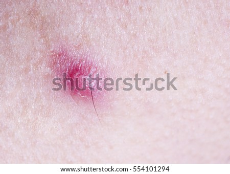 human skin with acne royalty free stock photos image 28330198 pustule stock images royalty free images vectors human skin with acne royalty free stock photos image 28330198 pustule stock images royalty free images vectors