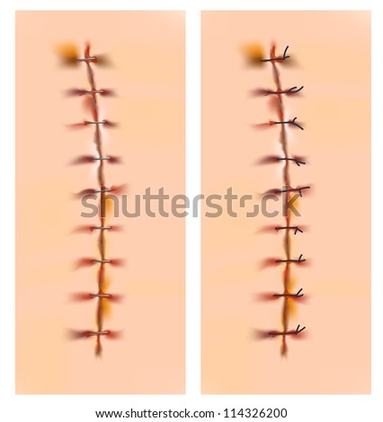 skin scar stock images royalty free images vectors skin stitches stock images royalty free images vectors skin scar stock images royalty free images vectors skin stitches stock images royalty free images vectors