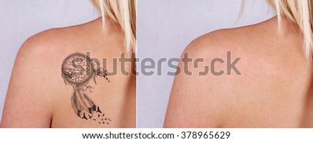 beautiful young woman before after laser stock photo 378965629 beautiful young woman before after laser stock photo 378965629