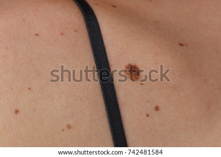 Birthmark Stock Images, Royalty-Free Images &amp; Vectors ...