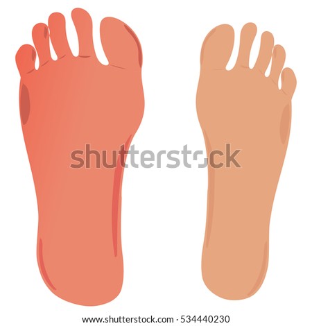 Vector Illustration Plantar Hyperkeratosis Foot Dry Stock Vector ...