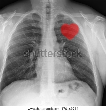 Red heart on x-ray chest. - stock photo