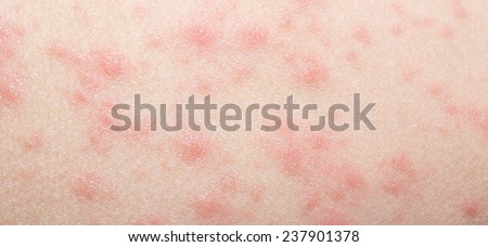 Rash Stock Photos, Images, & Pictures | Shutterstock