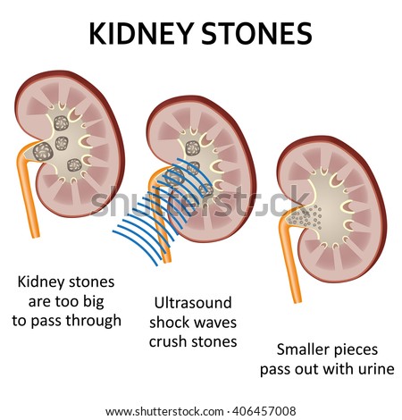 Kidney Stones Stock Images, Royalty-Free Images & Vectors | Shutterstock