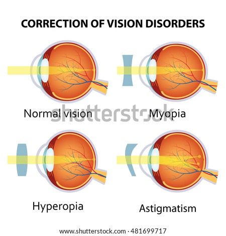 Diet For Correction Of Myopia And Hyperopia