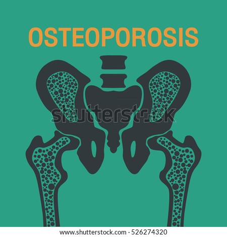 Osteoporosis Stock Images, Royalty-Free Images & Vectors | Shutterstock