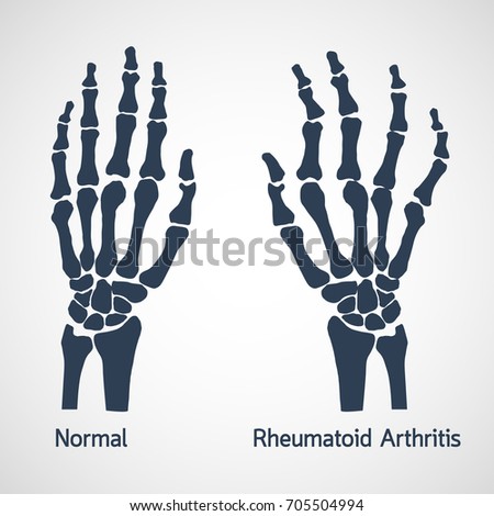 Arthritis Stock Images, Royalty-Free Images & Vectors | Shutterstock