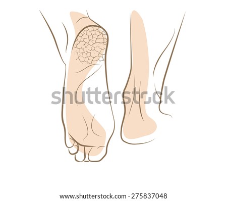 Khái niệm về nấm chân với gót chân nứt, ký họa vector