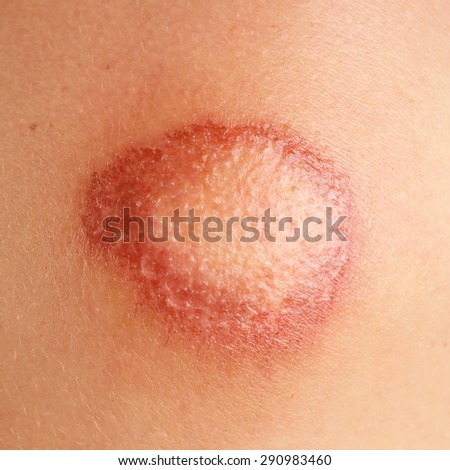scar on human skin stock photo 209040517 scar on human skin stock photo 209040517 scar on human skin stock photo 209040517 scar on human skin stock photo 209040517