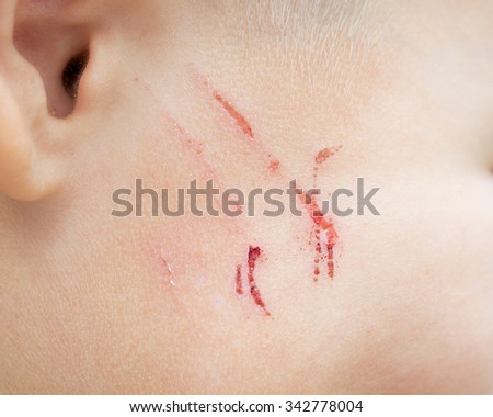 skin scar stock images royalty free images vectors scar stock images royalty free images vectors skin scar stock images royalty free images vectors scar stock images royalty free images vectors